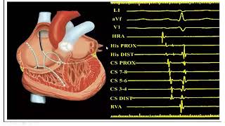 Introduction into intracardiac tracing part 1 [upl. by Frederica]