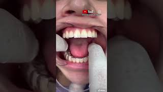 ¡🔥Instalación de férulas dentales RETENEDORES DENTALES🔥 [upl. by Diskin280]