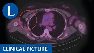 COVID19 mRNA vaccinerelated adenopathy mimicking metastatic melanoma [upl. by Lotson303]