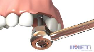 Implantes Dentales IMETI  Proceso Quirúrgico en la colocación de un implante [upl. by Bowles951]