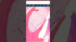 Gotitas 💦 💦 de Odontoma oralpathology oralpath odontomas [upl. by Alleram]