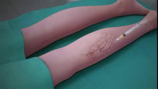 Sclerotherapy Procedure [upl. by Lynelle]