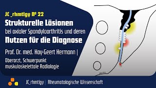 JCrhmtlgy 22 „Strukturelle Läsionen bei axSpA und deren Nutzen für die Diagnose“ [upl. by Sire]