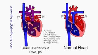 61 Truncus Arteriosus RAA ps [upl. by Hoag]