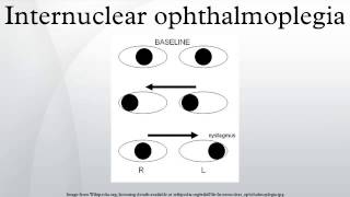 Internuclear ophthalmoplegia [upl. by Nnylidnarb]