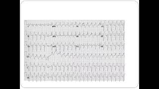 Fascicular VT  Dr Akif Baig [upl. by Erreit327]