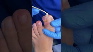 DEDO CON FIBROMA ingrowntoenailsurgery [upl. by Zul]