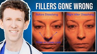 Under Eye Fillers Gone Wrong How to Fix Them [upl. by Ethbun]