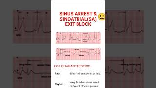 Sinus Arrest and Sinoatrial Exit Block شرح باللغة العربية [upl. by Hsital]