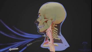 Breathing with a Tracheostomy Tube [upl. by Elbertina]