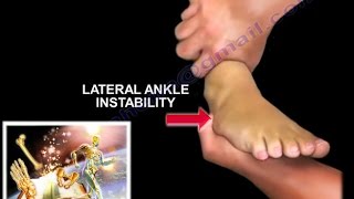 Chronic Lateral Ankle Instability  Everything You Need To Know  Dr Nabil Ebraheim [upl. by Nasho491]