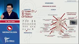 Síndrome 13 síndrome 21 síndrome 18  Neonatología 2024 [upl. by Ullyot]