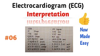 How to Read an ECG interpretation  06 QRS Complex [upl. by Danie]