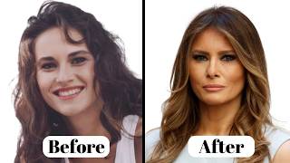 Melania Trump NEW LOOK  Plastic Surgery Analysis [upl. by Animrelliug]