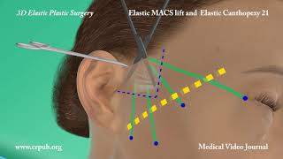 51 Elastic MACS lift and elastic Canthopexy [upl. by Ithsav220]