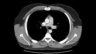 Anatomy of CT scans Thoracic cavity [upl. by Zarihs]