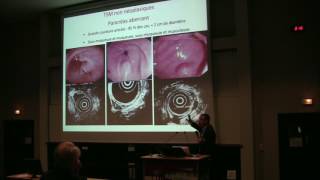 Aspect en endoscopie et échoendoscopie des tumeurs sousmuqueuses digestives  Dr L PALAZZO Paris [upl. by Naiva]