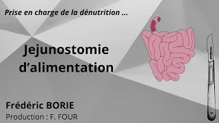 Pose de jéjunostomie dalimentation [upl. by Riedel]