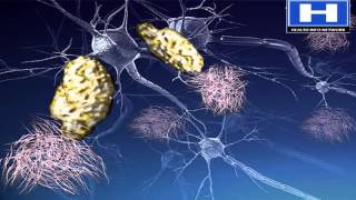 Alzheimers disease Pathophysiology Symptoms Causes and Treatment  3D animation [upl. by Derfniw]