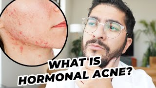 Hormonal Acne Explained [upl. by Nylaras]