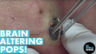 The POPS That Altered My Brain Chemistry 20 Minutes Dr Pimple Popper Best Of [upl. by Conah]