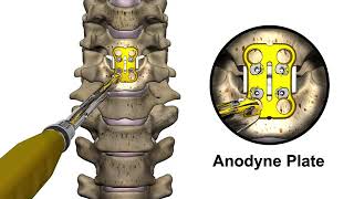 CoreLink Surgical Anodyne Plate System [upl. by Yreva730]