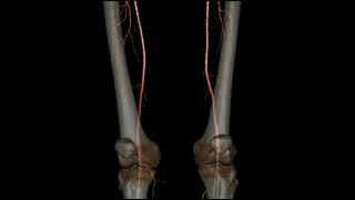 Angio tomografia 3D de Miembros Inferiores en tomografo GE ACT REVOLUTION [upl. by Rentsch]