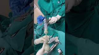 How to treat infected hip replacement  hipreplacementsurgery antibiotic spacer [upl. by Alistair]