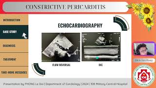 Constrictive pericarditis [upl. by Yemiaj]