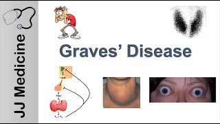 Graves Disease and Graves Ophthalmopathy  Signs Symptoms Diagnosis and Treatment [upl. by Araik]