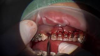 Autotransplantation impacted canine [upl. by Terence]