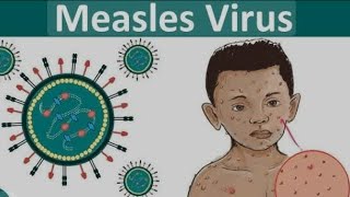 TOPICquot31MEASLES DISEASEamp ITS  DIAGNOSIS SYMPTOMS SIGNS PREVENTION COMPLICATIONS TREATMENT [upl. by Adyol]