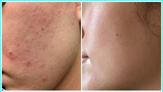 EXTREME ACCUTANE TRANSFORMATION BEFORE amp AFTER PHOTOS [upl. by Aracaj422]