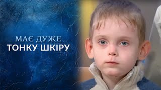 СБОЙ ГЕНОВ ИЛИ ПРОКЛЯТИЕ Эти Дети — загадка природы quotГоворить Українаquot Архів [upl. by Ayak]