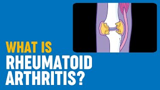 What is rheumatoid arthritis [upl. by Ruben694]