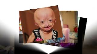 Youtuber Adalia Rose Texas star dies at 15 from rare medical condition [upl. by Nadaba]