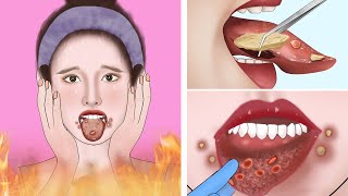 ASMR Canker sores cause of mouth ulcer treatment  Tonsil stone removal animation [upl. by Dib]