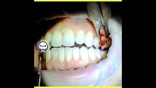 Peripheral Ossifying Fibroma Excision on Buccal Gingiva [upl. by Nnyllaf]