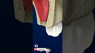 Sinus Lift Surgery  3D Animation [upl. by Weathers]