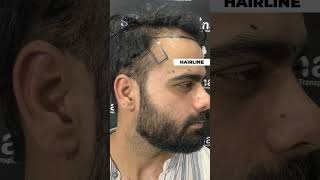 Hair Transplant Success Story at Skinaa Clinic  Patient Feedback viral shorts [upl. by Constant469]