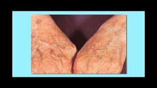 Actinic Keratosis Precancerous Skin Cancer [upl. by Yhtimit]