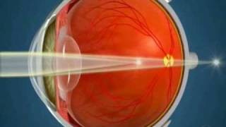 How Orthokeratology Works [upl. by Onra]