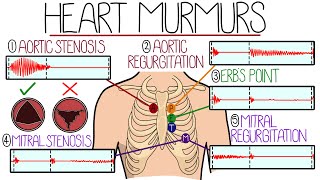 Examples of mitral stenosis murmurs [upl. by Hayimas]