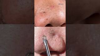 Blackheads Whiteheads Remove  Treatment  ब्लाक हेड्ज़ को कैसे निकाले  Skincare Tips shorts [upl. by Iruam]