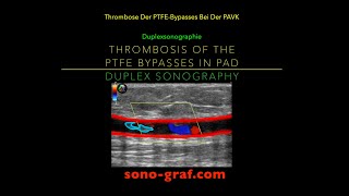 Duplexsonographie  Thrombose Des Bypasses Bei Der Peripheren Arteriellen Verschlusskrankheit [upl. by Dole]