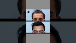 Incredible Hair Transplant Journey  Dadu Medical Centre hairlosscure [upl. by Amalia]