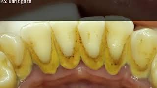 Ultimate Teeth Cleaning Treatment  Easy Tips for a Brighter Smile [upl. by Nnayar]