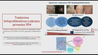 Sesión clínica Aproximación diagnósticoterapéutica a los Procesos Linfoproliferativos Cutáneos [upl. by Nagel21]