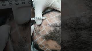 Demo19 Intralesional triamcinolone for alopecia areata [upl. by Ariaek]