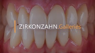 Minimally invasive restoration with ultrathin zirconia veneers  ZirkonzahnGalleries [upl. by Eidroj]